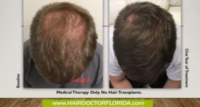 Affordable Hair Transplant in Florida.jpg
